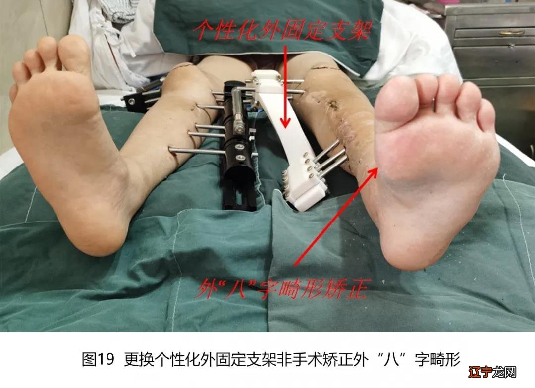 招风耳整形后期评价_招风耳好不好_招风耳整形