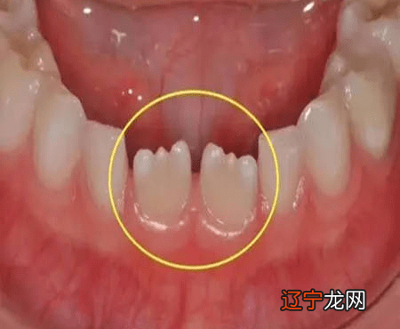 梦见牙齿全部松动脱落_梦见牙齿松动一拔就掉了_总是梦见牙齿一拔全掉